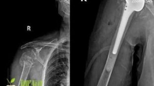 儋州市人民医院骨二科成功开展人工肱骨头置换术