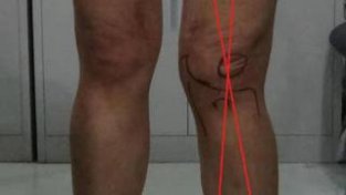 O型腿和X型腿需要矫正！医生：这是膝关节畸形，影响美观和健康