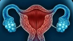 妇科体检时发现的子宫肌瘤，这4种请况医生建议手术切除