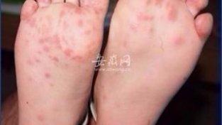 安徽省疾控中心提醒：手足口病4～7月进入高发期