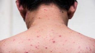 春季水痘多发，儿童水痘如何防治？