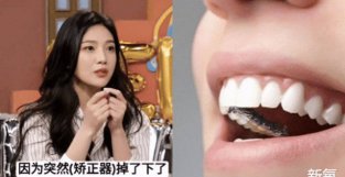 为什么日本女星都爱去牙齿矫正？