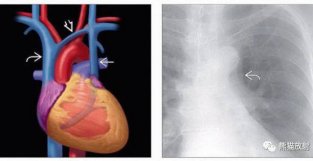 胸部影像诊断图例：体循环发育异常（奇静脉、腔静脉、主动脉）