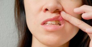 口腔溃疡久治不愈警惕口腔癌？关于它的4个真相，多数人都不知道