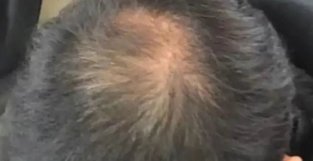 秃顶男子自称半月不用洗发水长出新头发！专家紧急提醒