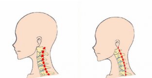 照镜子？脖子夹纸？怎么知道自己的颈椎有没有生理曲度变直或反曲