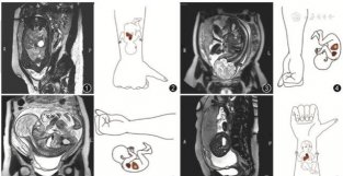 胎儿MRI丨学习用“右手法则”判定胎儿的左右方位