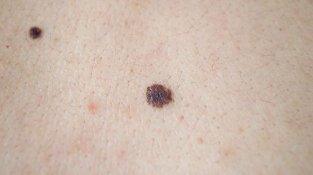 要学会识破黑SE素瘤的“伪装”，4招教你辨别黑SE素瘤和痣的区别