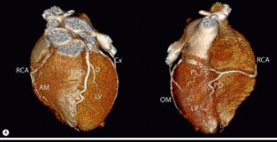 冠状动脉CT：相关概念、解剖