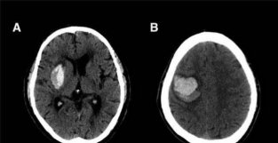 CT图像中脑出血血肿扩大的十个征象（上）