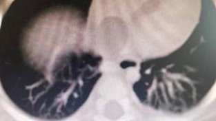 1岁男童肿瘤从肾脏长进心脏！重庆多学科专家联手摘瘤