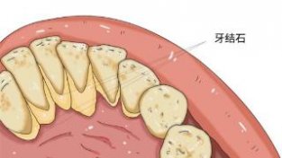牙齿上的黄泥到底是什么，牙齿上的黄泥到底是怎么产生的