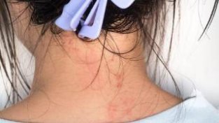 应该怎样预防反反复复的湿疹缠身？