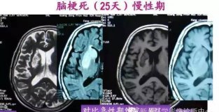 脑梗死的MRI分期图解