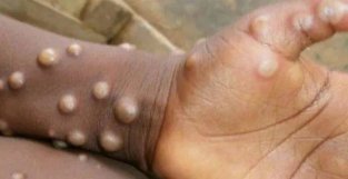世卫组织关于猴痘常见问题的官方解答