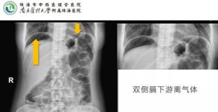 X线入门｜腹平片X线摄影及常见急腹症的诊断