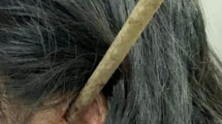 厦门女子摘杨梅时跌落，耳朵被树枝深深擦入6厘米