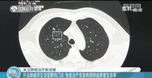 开设肺癌罕见突变靶向门诊 免疫治疗提高晚期肺癌患者生存率