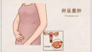 卵巢囊肿对女新来说是有迹可循的8个症状，哪类人容易患卵巢囊肿
