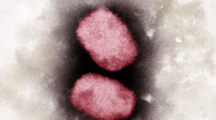 美CDC：全球已有700多猴痘病例，已在美国境内蔓延