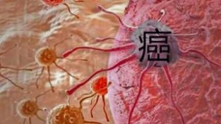 医生提醒：中国癌症高发，3种肉要少吃