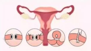 什么是输卵管吻合术？