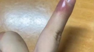 重庆女子拔倒刺手指肿一周，上网一查吓得重视：不是化脓就是截肢