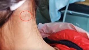 湖南9岁女童被蜱虫钻进头皮1个月，仅剩肚子在外面