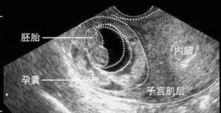 怀孕60天未见胚芽，正常吗？