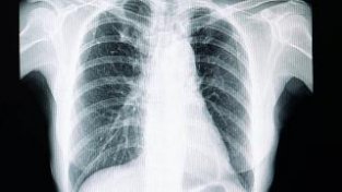 肺癌，从查出到死亡需要多久，关键看这4点