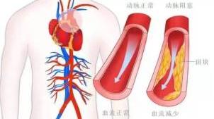 冠心病心肌缺血有什么症状和表现？心肌缺血吃什么要？