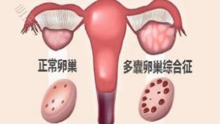 如何判断多囊卵巢综合症呢？