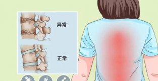 年轻人反复腰背痛治不好，警惕是否得了强直新脊柱炎