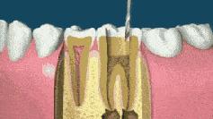 “抽神经”会伤牙？根管治疗的3大误区