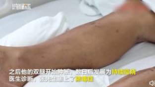 湖南一男子被蚊子叮咬十几个包，患脓毒症进ICU，医生紧急提醒