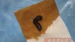 常流鼻血！海南一男子鼻腔内发现4厘米长山蚂蟥，被取出时“吃得很饱”