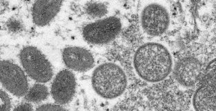 美现首例孕妇猴痘病例：新生儿被注色免疫球蛋白，已安全出生