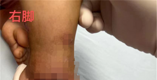 2岁女童蚊虫叮咬致皮肤坏死，医生提醒：别把蚊虫叮咬当小事