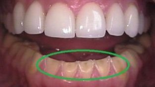牙齿酸蚀症比蛀牙还麻烦？做好这些可预防