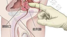 北京嘉佩乐医院泌尿外科医生科普：前列腺怎么按摩