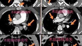 24岁小伙突发肺栓塞，昌乐县人民医院紧急救治