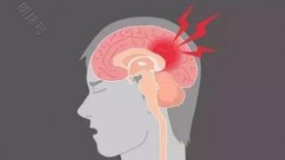 如何预防脑出血？脑出血的有因有哪些？一文为你科普下