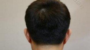 惠州植发技术好的医院排行榜|麦穗植发医生讲解：植发后饮食