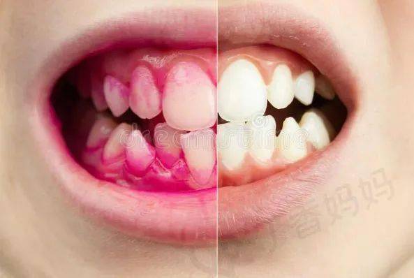 清洁孩子的牙齿，4 个护理方法家长一定要知道