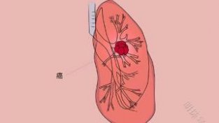 肺炎和肺癌，为啥容易被误诊？一文学习下