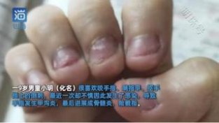 常见的手指起倒刺原因，有以下几种，建议多了解下