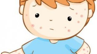 常见的5类儿童荨麻疹病因及其特点，一文学习下