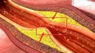 颈动脉斑块怎么形成的，它是血栓吗？一文了解清楚