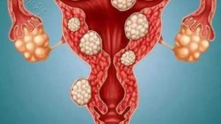 子宫肌瘤是什么原因引起的？一文了解清楚