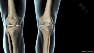 膝关节骨新关节炎疼痛怎么办？10个注意事项大家要重视